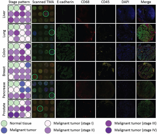 E-cadherin/CD68/CD45 triple staining of multiple TMAs.