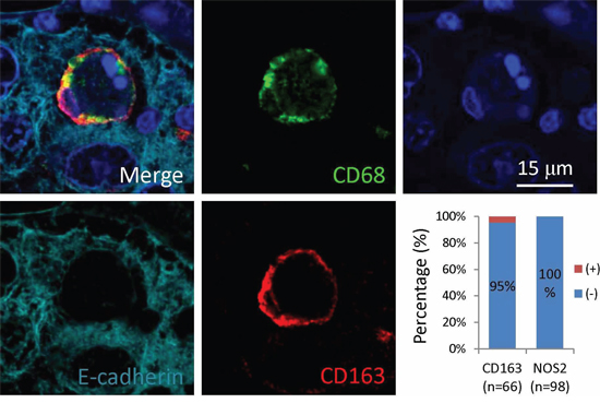 Macrophages positive in CD163 participate in CICs formation in human tumors.
