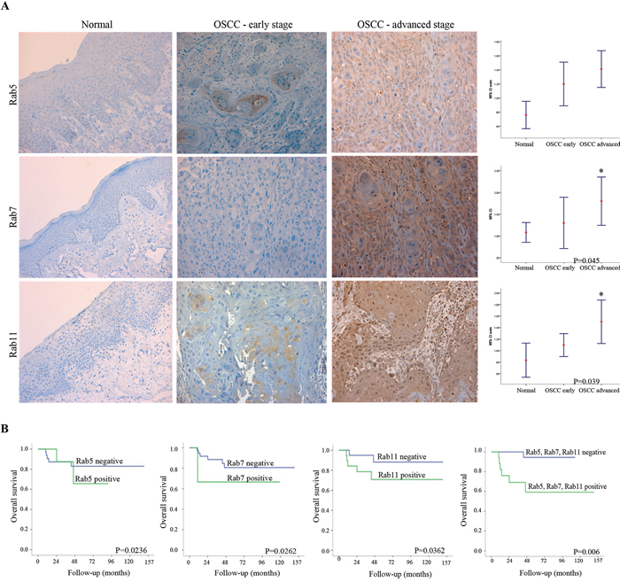 A. Representative images of immunostaining for Rab5, Rab7 and Rab11 proteins in normal (left side) and OSCC samples (right side).