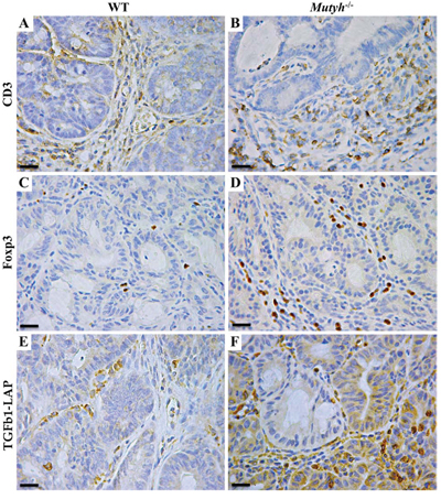 Lymphocyte infiltrate, Foxp3 and TGF&#x03B2;1-LAP expression in adenomas developed in AOM/DSS-treated wild-type and Mutyh&#x2212;/&#x2212; mice.