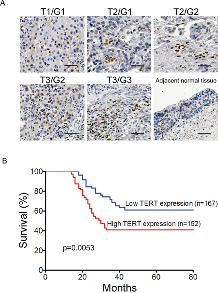 TERT is consistent with clinical severity and prognosis of bladder cancer.