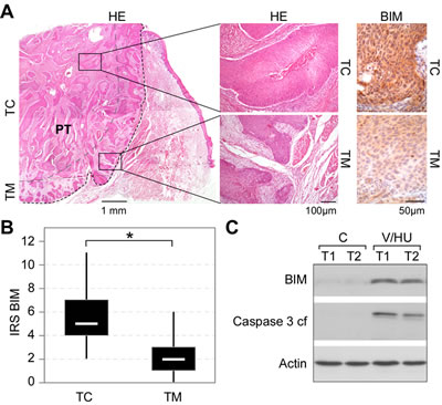 BIM expression in tumor biopsies from head and neck carcinoma patients.