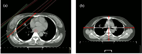 Definition of anatomic parameters: A = breast separation (red), B = thorax depth (white), C = thorax width (white), D = body depth (red), E = body width (red).