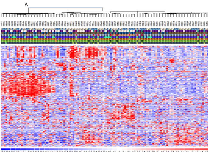 mRNA and miRNA signatures for hyperdiploid MM classification.