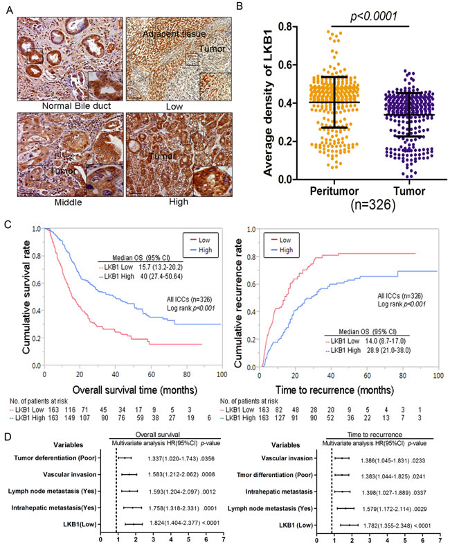 Decreased expression of LKB1 correlates with poor prognosis in cholangiocarcinoma patients.