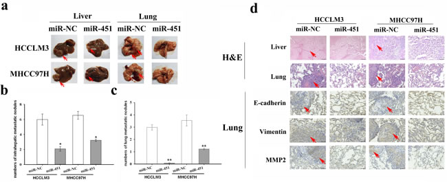 Re-expression of miR-451 inhibits metastasis of HCC cells