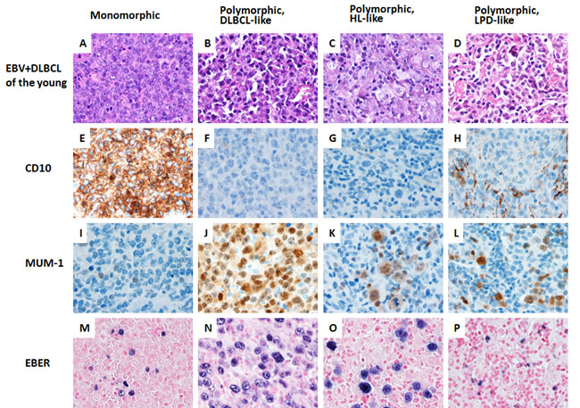 A spectrum of morphologic variants and immunophenotypic profiling in EBV-positive diffuse large B-cell lymphoma of the younger patients.