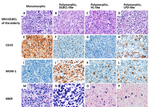 A spectrum of morphologic variants and immunophenotypic profiling in EBV-positive diffuse large B-cell lymphoma of the elderly patients.