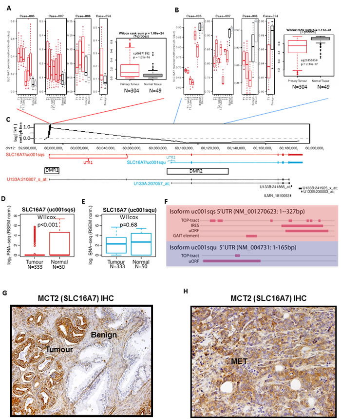 A selective demethylation at the SCL16A7 locus occurs in PCa compared to benign tissue.