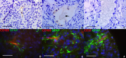 Glioma tumor-derived endothelial marker expression