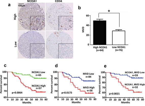 NCOA1 protein expression and its correlations with human breast tumor microvascular density (MVD) and patient survival.