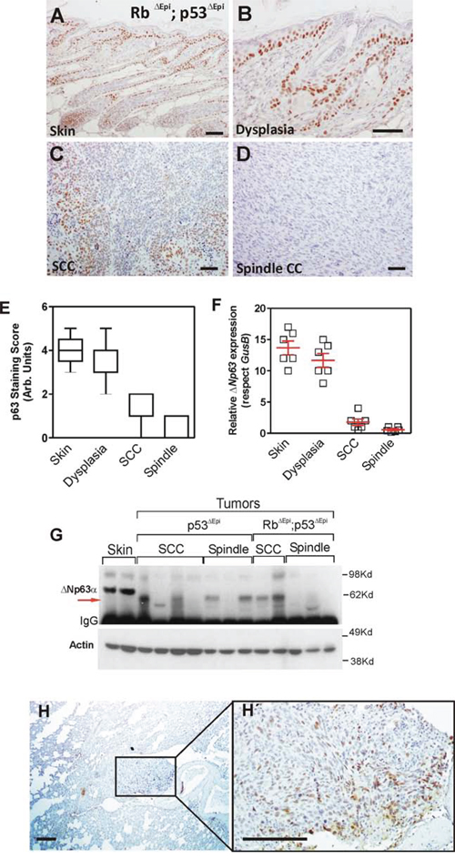 &#x0394;Np63 downregulation is an early event in spontaneous Trp53-deficient epidermal tumors.