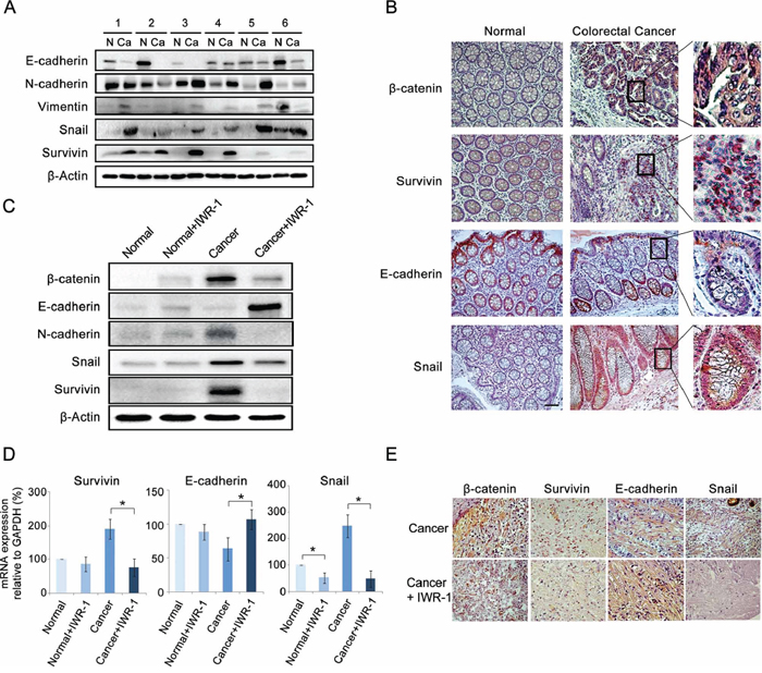 IWR-1 suppression of the EMT in the ex vivo model of colorectal cancer.