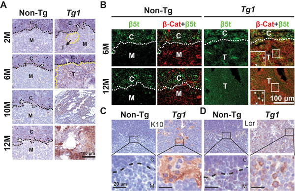 Aberrant &#x3b2;5t and squamoid differentiation markers expression in Tg1 mouse thymomas.