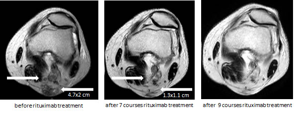 Complete regression of the metastases in the left popliteal region during rituximab therapy.