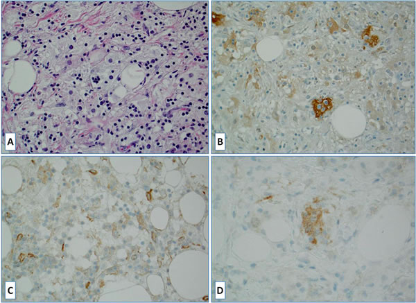 A case of Rosai-Dorfman disease: