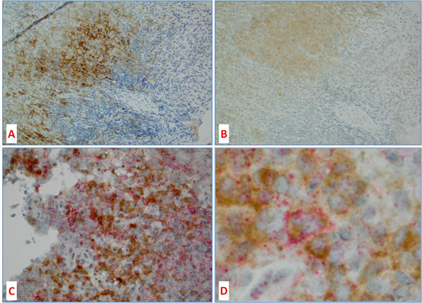 Co-localization of BRAFV600E protein and PD-L1 in histiocytic tumors.
