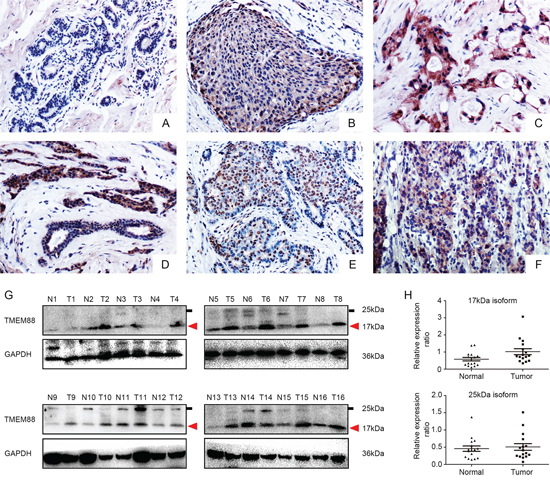 Expression and localization of target protein transmembrane 88(TMEM88) in breast cancer tissues.