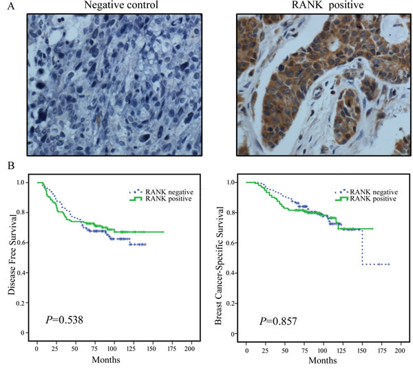 Representative images of RANK immunohistochemical staining in breast cancer tissues and the prognostic value of RANK in breast cancer patients.