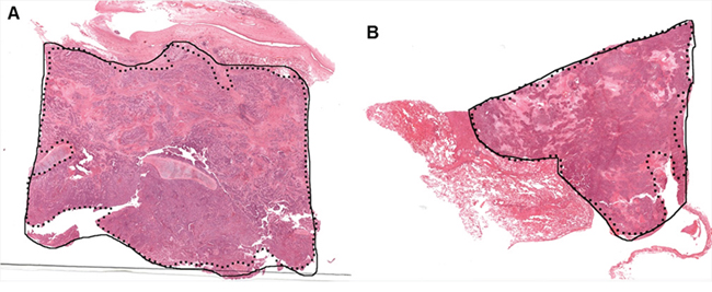 Two examples A. and B. showing the comparison between pathologist annotation (solid black line) with the automated macrodissection method (dotted black line) on H&#x0026;E stained lung images.