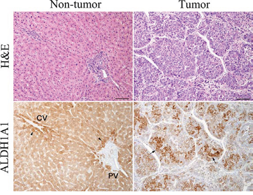 Hematoxylin-eosin (H&#x0026;E) staining and immunohistochemical staining of ALDH1A1 in tumorous and non-tumorous tissue in HCC.