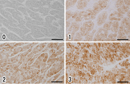 Immunohistochemical evaluation of ALDH1A1 in HCC.