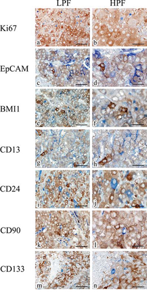 Representative double-staining immunohistochemistry for ALDH1A1 (brown) and Ki67 (blue), EpCAM (blue), BMI1 (blue), CD13 (blue), CD24 (blue), CD90 (blue) and CD133 (blue) in HCC specimens.