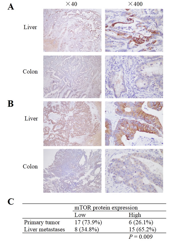 mTOR expression in primary colorectal cancer and corresponding liver metastases.