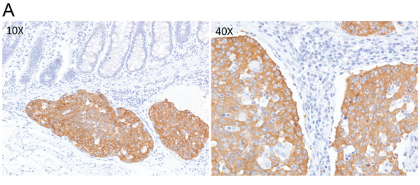Figure 1A: ALK IHC (3+) staining in a rectal adenocarcinoma patient tumor sample.