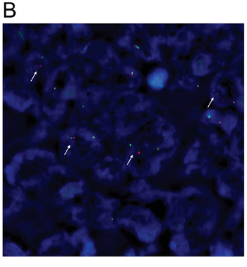 Figure 1B: Detection of ALK rearrangement by ALK break-apart by fluorescence in situ hybridization (FISH) in the ALK IHC (3+) rectal adenocarcinoma patient (white arrows).