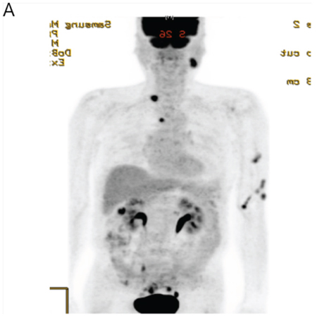 Figure 3A: 2-deoxy-2-(18F)fluoro-D-glucose positron emission tomography (PET) scan of the EML4-ALK CRC patient at the time of presentation demonstrating metastatic retroperitoneal and cervical lymph nodes metastasis.