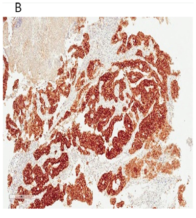 Figure 3B: ALK IHC showing strong diffuse staining of ALK antibody (3+) of the EML4-ALK (E21; A20) adenocarcinoma of the colon patient after palliative resection.