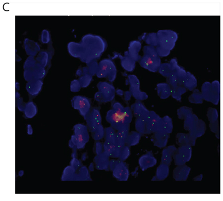 Figure 3C: Break-apart ALK FISH of the EML4-ALK (E21;A20) colon patient demonstrating the presence of breakapart signals in 50% cells.