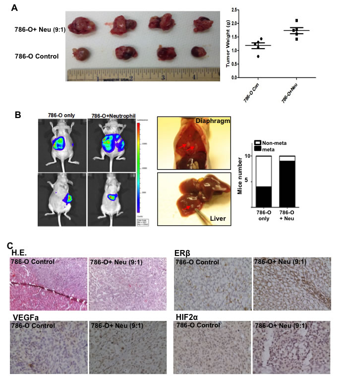 Tumor associated neutrophils could promote RCC invasion in orthotopically implanted RCC model.