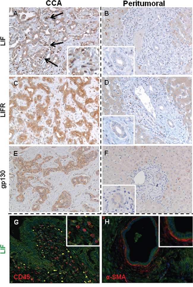 LIF, LIFR and gp130 immunohistochemical expression in CCA and peritumoral areas of human liver samples.