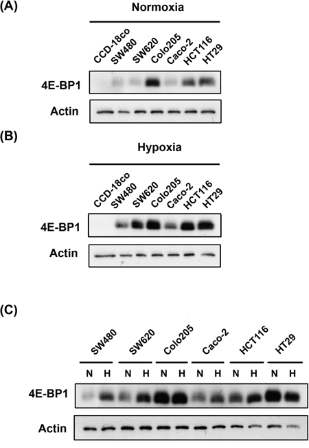 Compare 4E-BP1 expression in normal and colorectal cancer cells under normoxia and hypoxia.