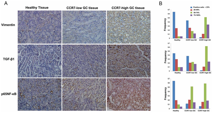 CCR7 facilitates EMT in clinical gastric cancer samples.