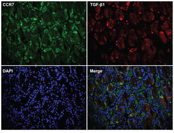 Double immunostaining revealed strong expression of TGF-&#x03B2;1 in CCR7-high gastric cancer samples.