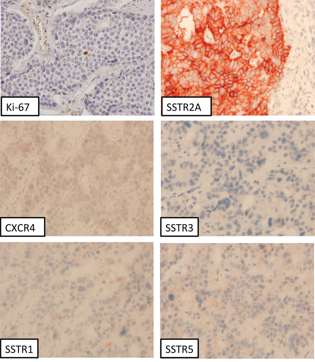 Liver metastasis of a neuroendocrine tumor (G1, Ki-67 &#x003C;2%); immunohistochemistry, counterstaining with hematoxylin; original magnification: x400