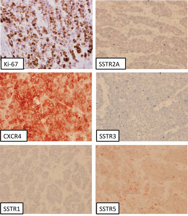 Neuroendocrine carcinoma of the colon ascendens (G3, Ki-67: 80%); immunohistochemistry, counterstaining with hematoxylin; original magnification: x400