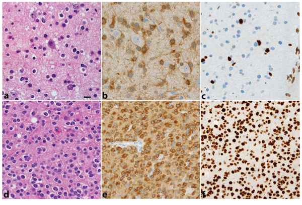 Two WHO grade II gliomas are illustrated.