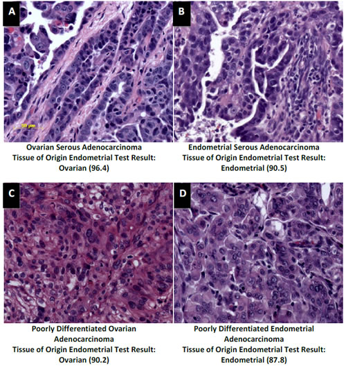 Distinction of ovarian and endometrial cancers by the Tissue of Origin Endometrial Test.