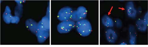 FISH analysis of Chromosome 7 and EGFR copy number alterations.