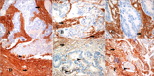 Immunohistochemical profile of the myofibroblastic stromal reaction in areas of invasion of CRC.