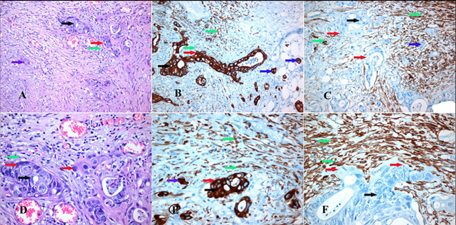 Immunohistochemical markers defining the cell populations of the tumor invasion front.
