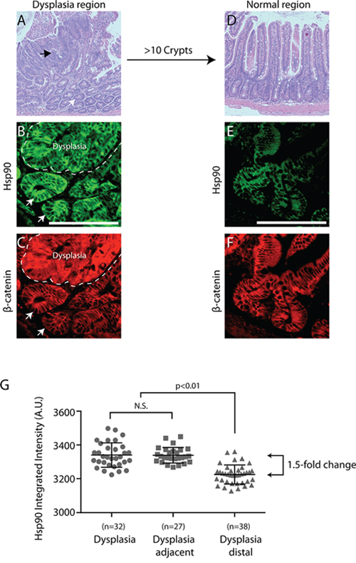 Hsp90 is elevated in normal cells adjacent to early cancer lesions - a &#x201C;field effect&#x201D;.