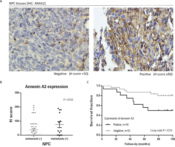 Association of annexin A2 (ANXA2) with clinicopathological variables in nasopharyngeal carcinoma (NPC).