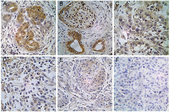 Immunohistochemistry (IHC) stained tissues of DKK1 in pancreatic diseases Tissues.