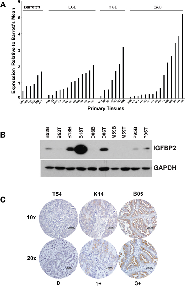 IGFBP2 expression in esophageal tissues and EACs.