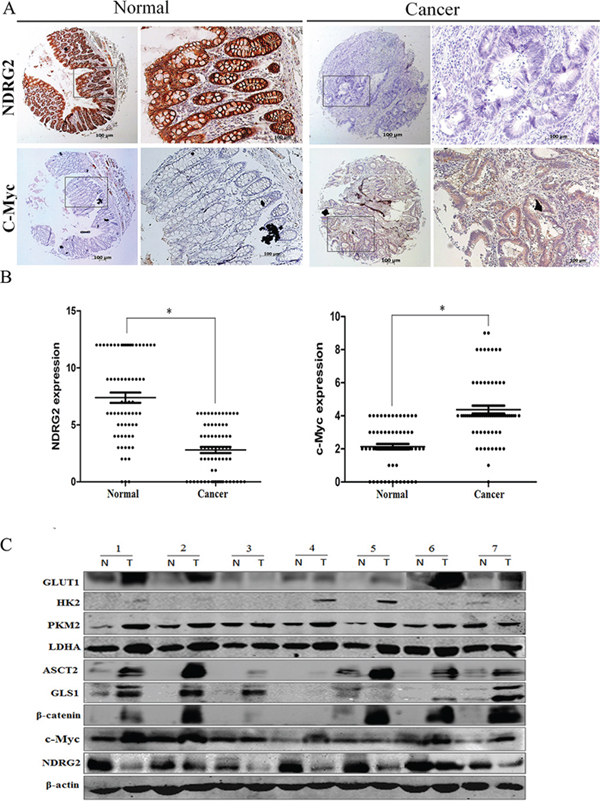 The expression analysis of NDRG2 and metabolism related molecules in clinical colorectal carcinomas.